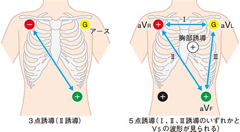 心電図 乳首|心電図電極を正しく装着しよう！ .